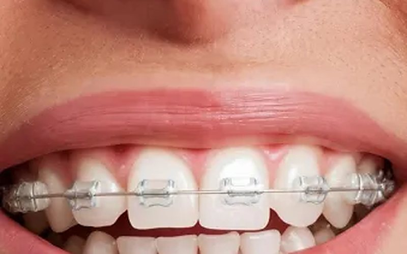 Ortodoncia con brackets esteticos en una paciente de la clinica dental en Las Palmas