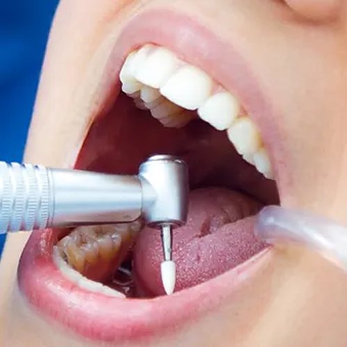 Endodoncia en la Clínica Dental Vidal Castellano, Las Palmas de Gran Canaria