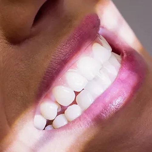 Estética dental en la Clínica Dental Vidal Castellano, Las Palmas de Gran Canaria