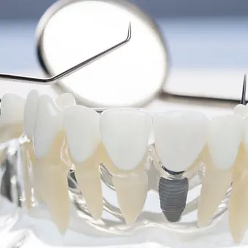 Implantes dentales en la Clínica Dental Vidal Castellano, Las Palmas de Gran Canaria