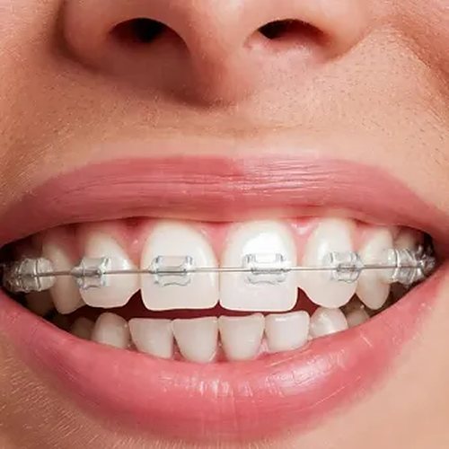 Ortodoncia en la Clínica Dental Vidal Castellano, Las Palmas de Gran Canaria